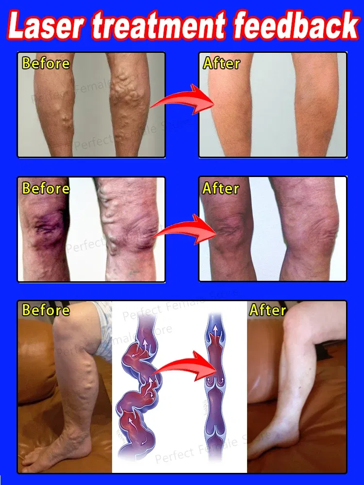 Color: green - Varicose Veins Products