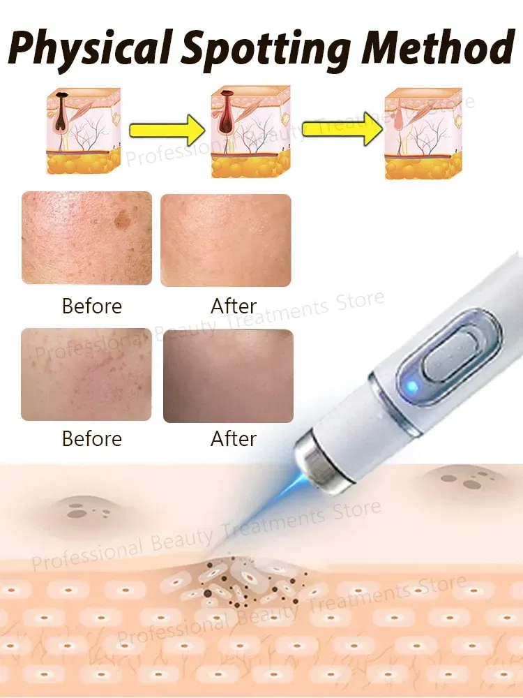 Color: black - ?…?«𝐞𝐜?¤𝐥𝐞 ?«𝐞?¦𝐨𝐯𝐚𝐥 Laser Therapy to Heal Spots