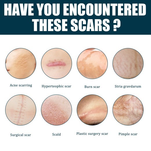Scar Gel Skin Hyperplasia Burning Care