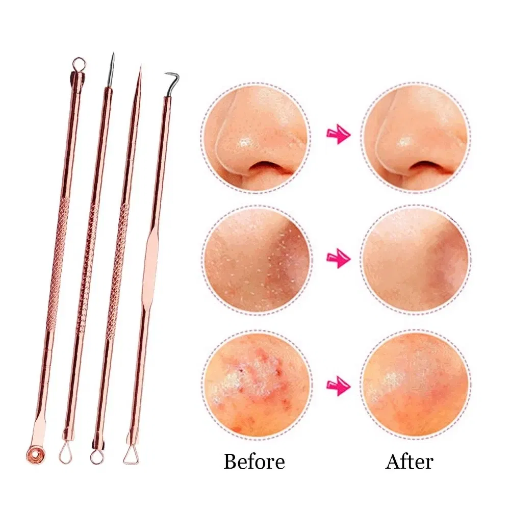 Color: WHITE - 4PCS Stainless Steel Acne Needle Electroplating Colorful Rose Gold Acne Needle Extrusion Blackhead Tool Can Be Customized LOGO